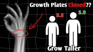 Watch this if you wanna Grow Taller With Closed Growth Plates 
