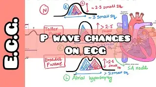 P Wave changes in ECG made easy for USMLE, NEET PG, NCLEX