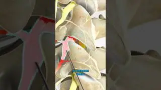Selective nerve root block (3D Animation)