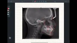 Cephalometric Superimposition using Notability