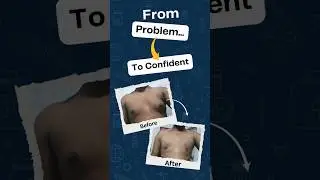 Painless Gynecomastia Surgery in India | Patient Testimonial at HeptaCare Health