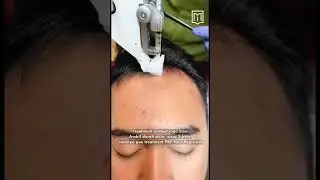 Nggak percaya diri karena botak? Yuk coba Treatment PRP Hair Regworth di MEN/O/LOGY !