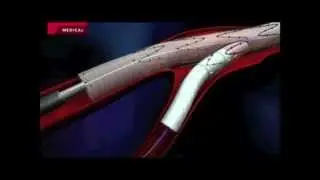 Intervencionismo Aórtico | Zenith Branch de Cook Medical
