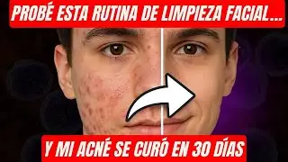 Prob&eacute; esta rutina de limpieza facial&hellip; y mi acn&eacute; se cur&oacute; en 30 d&iacute;as