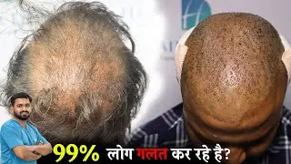 99% People Choose the Wrong Hair Transplant Clinic | India 2026
