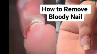 How to remove  Nail when HURT AND BLOODY  Nail Properly