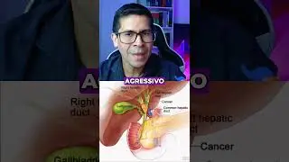 Top 5 C&acirc;nceres Digestivos Mais Letais - 3 lugar: Colangiocarcinoma Hilar!