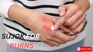 Quick Relief for Palm Burns | Sujok Therapy + Easy Home Remedies