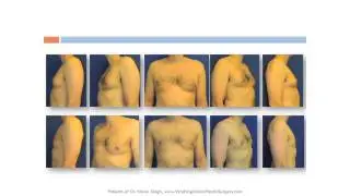 Gynecomastia, Chest Liposuction, Male Breast Reduction