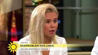 Lisa Ajax drabbades av hudsjukdomen rosacea: 