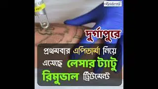 Best Tattoo Removal in Durgapur | Alma Q & Pico Laser | Safe & Effective Treatment
