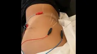 disc bulge, sciatica pain acupuncture therapy 21/4/2025 live stream agra