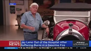Jay Leno released from hospital after receiving treatment for burns