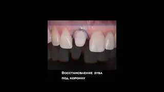 Реставрация и протезирование: что изменилось в улыбке #улыбка #протезирование #зубы #shorts
