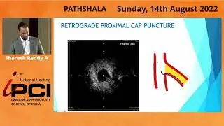 DR.SHARATH REDDY- A IVUS IN CTO INTERVENTION IN ANTEGRADE & RETROGRADE APPROACHES