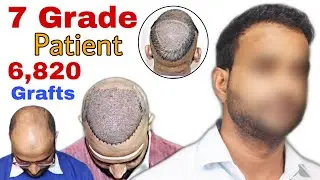 Best Hair Transplant Result 2020 || 7 Grade Patient || 6,820 Grafts || Regrow Clinic Haridwar