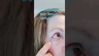 Antlitzanalyse: Eisenmangel. Chromodiagnostic: ferrum deficiency #shorts #accentface
