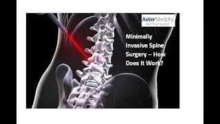 Minimally Invasive Spine Surgery &ndash; How Does It Work?