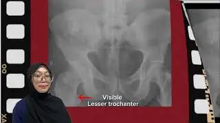 Case study of Pelvic Chondrosarcoma