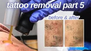 The Pain Gets Worse | Tattoo Removal Part 5