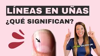 L&iacute;neas en las u&ntilde;as: Dermat&oacute;loga lo explica.