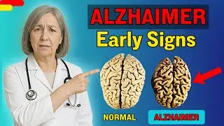 Alzheimer's Doesn't Start With Memory Loss: Here's What Actually Happens