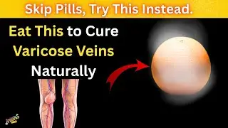 Seniors Eat This to Cure Varicose Veins Naturally: A Doctor&rsquo;s Guide.