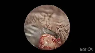 Excision of External Auditory Canal Osteoma