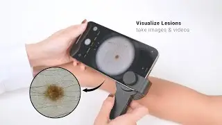 IBOOLO DE 3100 dermatoscope