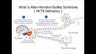 What is Allan-Herndon-Dudley syndrome (MCT8 deficiency)