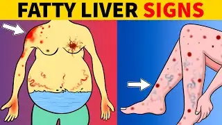 8 Signs That Could Indicate Fatty Liver Disease | JoyHealth