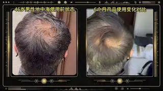 Male Mediterranean, Transformation Process 180 Days, Using 120ML Product, Age 46