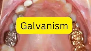 What is galvanism in dentistry?