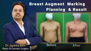 Breast Augment Planning, Marking & Result  | Male to Female Boob Job in Kolkata | Silicon Implant