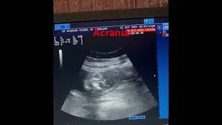 Fetal acrania