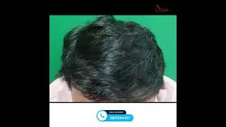 Hair Transplant Review by Patient After 1 year | Divine Hair Transplant Result #shortsfeed