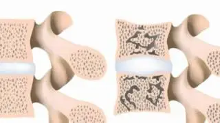 Herniated Disc| 925 344-4162|Walnut Creek Ca 94526|Sciatica Treatment|Neck Exercises|Back Pain Gone