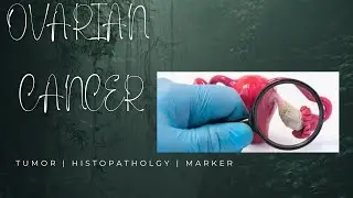 OVARIAN CANCER | OVARIAN TUMOR