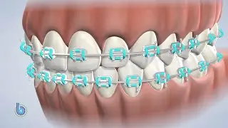 Rubberbands Instructions in Omaha NE | Braces Omaha