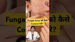 How to treat Fungal Acne on face? | Fungal Acne Treatment  #fungalacne #acne #skincare #shorts
