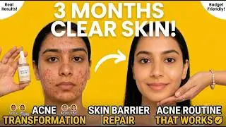 Acne Solution | AM PM Routine + Pro Tips | 3 Months Guaranteed Result (Budget Friendly)