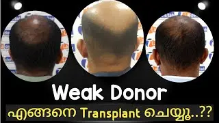 എങ്ങനെ ആണ് ഒരു Weak Donor Area ഉള്ള തലയിൽ Hair Transplant ചെയ്യുക..? 😇