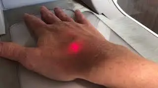 Fractional CO2 Laser Hand Resurfacing