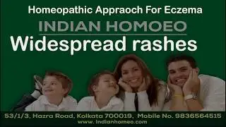 Eczema Treatment In Homeopathy - homeopathic medicine for eczema || Dr Sudha Tiwari || Indian Homeo