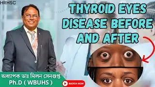 Thyroid eye disease treatment in homeopathy | Graves Eye Disease | TED | Patient Review