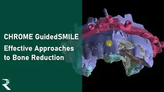Effective Approaches to Bone Reduction in a CHROME GuidedSMILE Natural Case