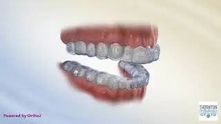 Indirect Bonding