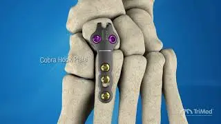 TriMed ASET Foot Plating System: Plates that fit like a glove