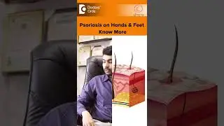 PSORIASIS on Hands & Feet |Palmoplantar Psoriasis Treatment-Dr.Rajdeep Mysore|Doctors' Circle#shorts