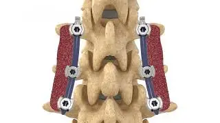 Attrax&trade; Synthetic Bone Void Filler